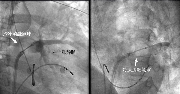 心房顫動新治療｜台大新竹分院引進醫學中心級冷凍導管消融手術-台大醫院新竹分院