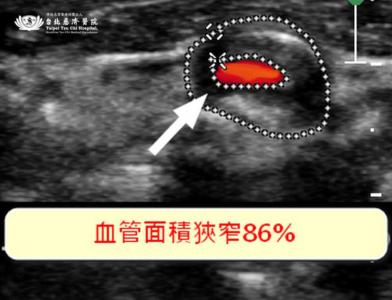血流剩一半還沒感覺？ 頸動脈超音波揪中風風險-台北慈濟醫院