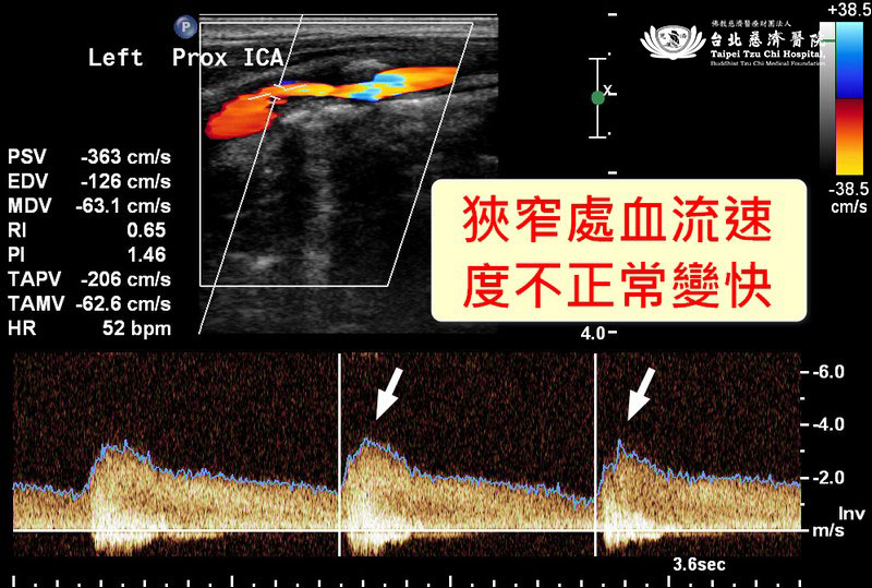 血流剩一半還沒感覺？ 頸動脈超音波揪中風風險-台北慈濟醫院