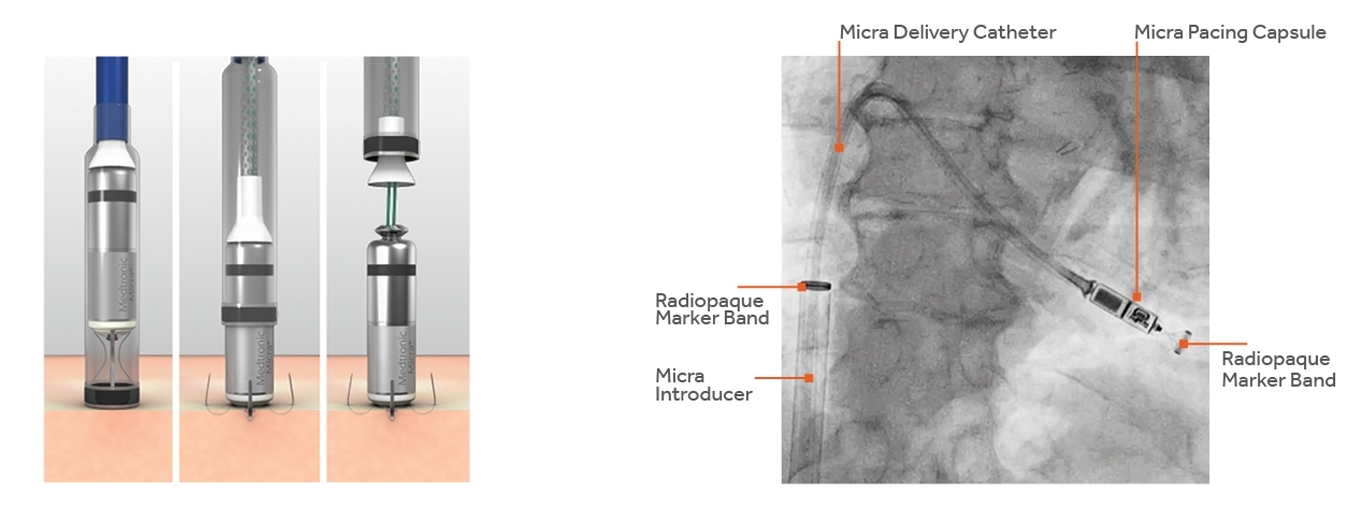 無導線心律調節器 Micra 來了！患者不用在忍受胸口凸一塊-專科護理師