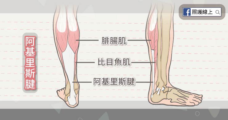 不是跑者也會得到的 – 阿基里斯腱肌腱炎-Achilles