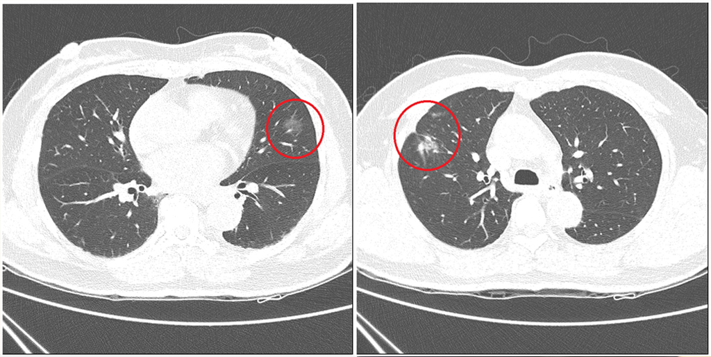 同時發現兩個肺癌？胸腔鏡手術一次切除-TCnews慈善新聞網