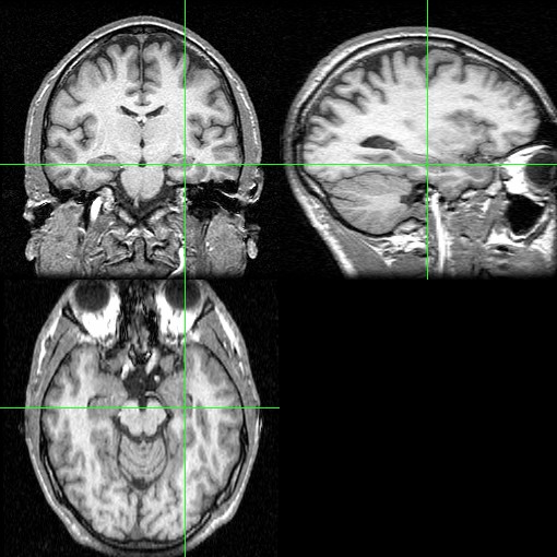 「懷孕會變笨」、「一孕傻三年」到底真的還是假的？-曾翌捷醫師