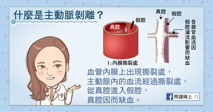 強烈撕裂性胸痛–主動脈剝離｜懶人包-上背痛