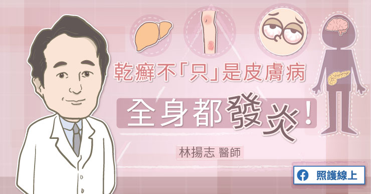 乾癬不「只」是皮膚病，全身都發炎！-克隆氏症