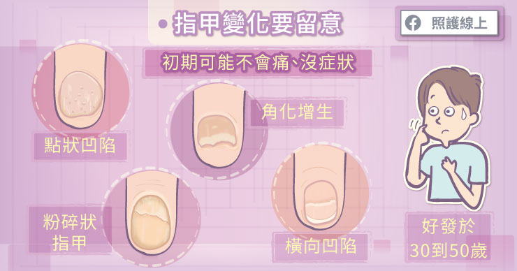 乾癬不「只」是皮膚病，全身都發炎！-克隆氏症