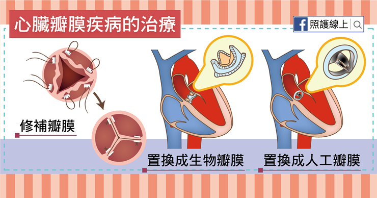 睡覺時有這徵兆，小心你的心臟瓣膜也出問題！醫師告訴你：為何「瓣膜脫垂」這麼危險-ECMO葉克膜