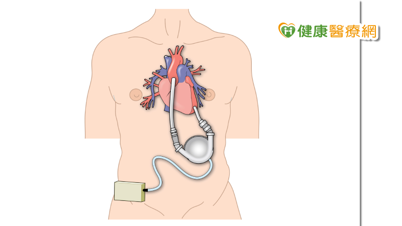 葉克膜、心室輔助器、全人工心臟怎麼分？ 醫師解析心臟輔助儀器-心室輔助器