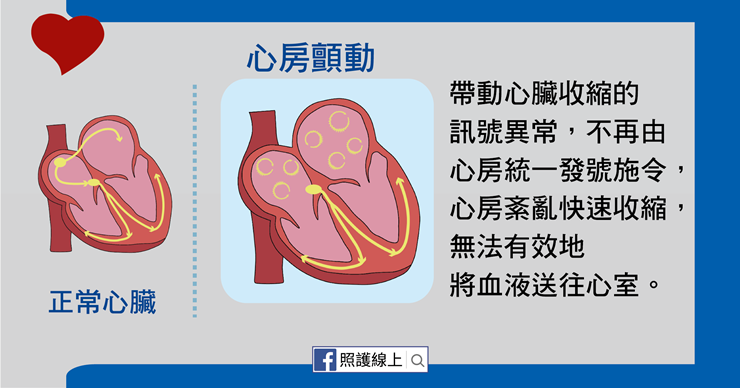 銀髮族「心房顫動」恐致死，醫師揭中風推手這5大族群要小心-中風