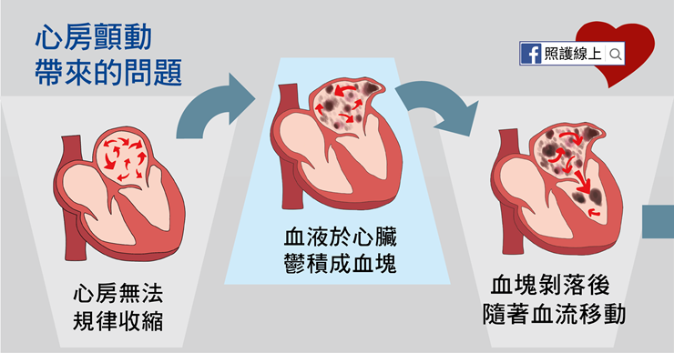 銀髮族「心房顫動」恐致死，醫師揭中風推手這5大族群要小心-中風