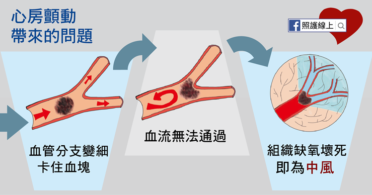 銀髮族「心房顫動」恐致死，醫師揭中風推手這5大族群要小心-中風