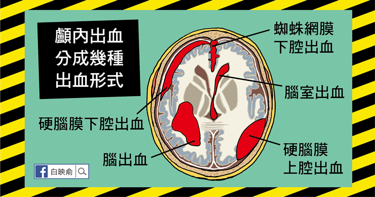 撞到頭沒症狀就沒事？出現這9種情況就可能有顱內出血！-白映俞醫師