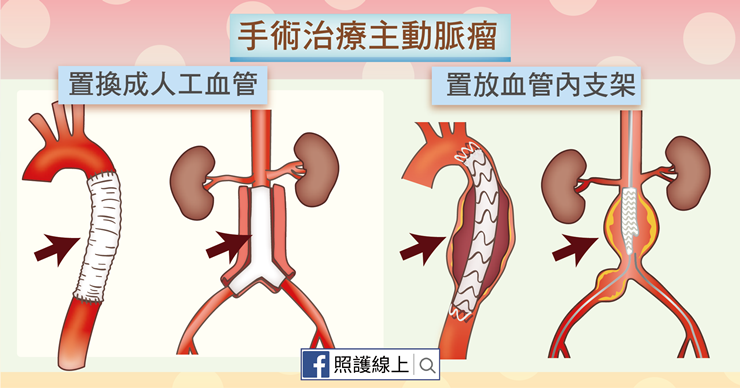 6旬翁喉嚨沙啞逾2周，竟是胸主動脈瘤剝離險喪命！-亞大醫院