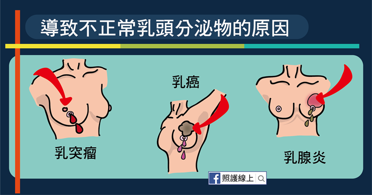 乳頭出現分泌物，到底正不正常？醫教從這三重點判斷-白映俞醫師