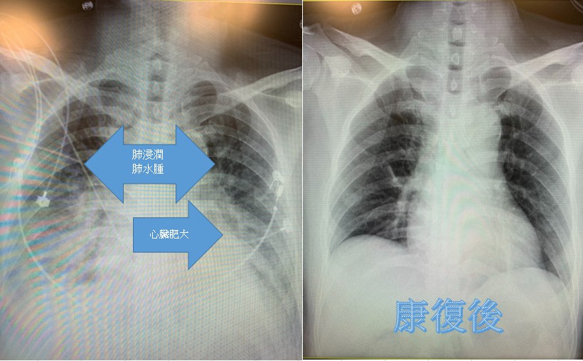 突胸悶、氣喘似新冠肺炎！醫護拼黃金時間冒險搶救：為了病人義無反顧-中醫大新竹附設醫院