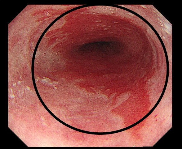 原以為只是胃食道逆流火燒心 檢查驚見10cm巴瑞特食道合併食道分化不良-內視鏡熱射頻燒灼術