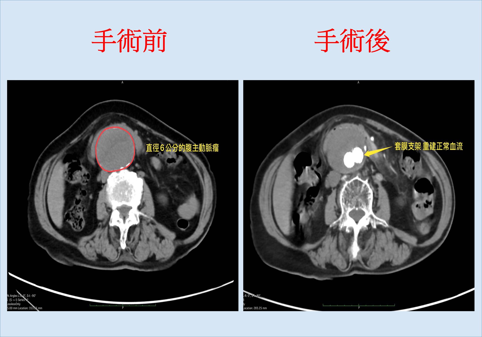 「怎麼辦？我的心臟掉到肚子！」怕爆送急診醫：破裂恐致死 ...-中醫大新竹附設醫院