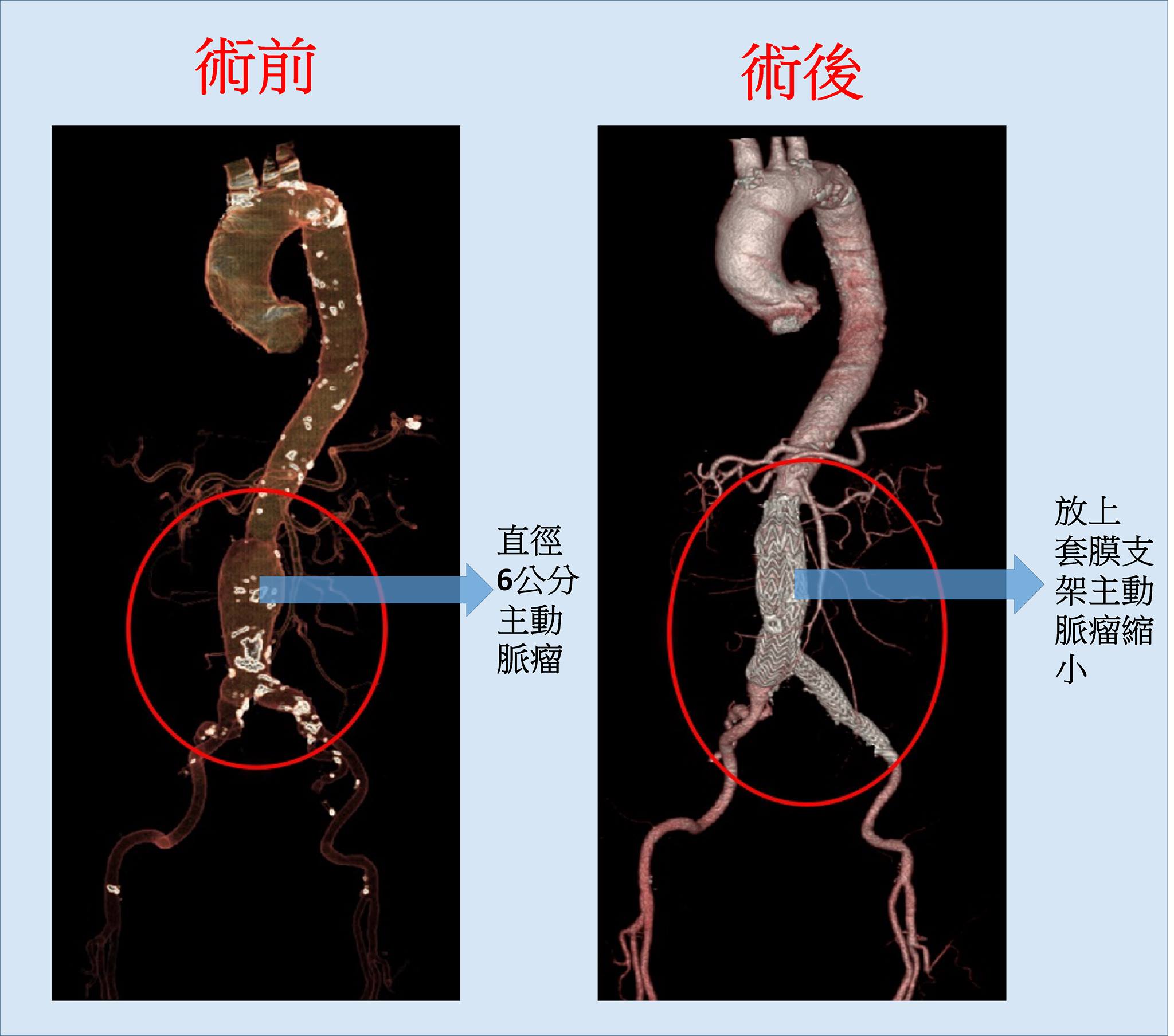 「怎麼辦？我的心臟掉到肚子！」怕爆送急診醫：破裂恐致死 ...-中醫大新竹附設醫院