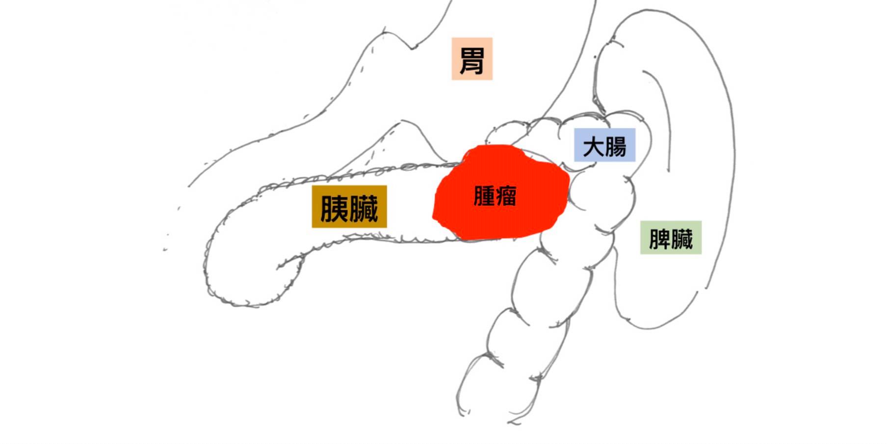 食慾不振、腹部悶痛！胰臟癌侵犯大腸造成腸阻塞 切除4器官保命-人工肛門