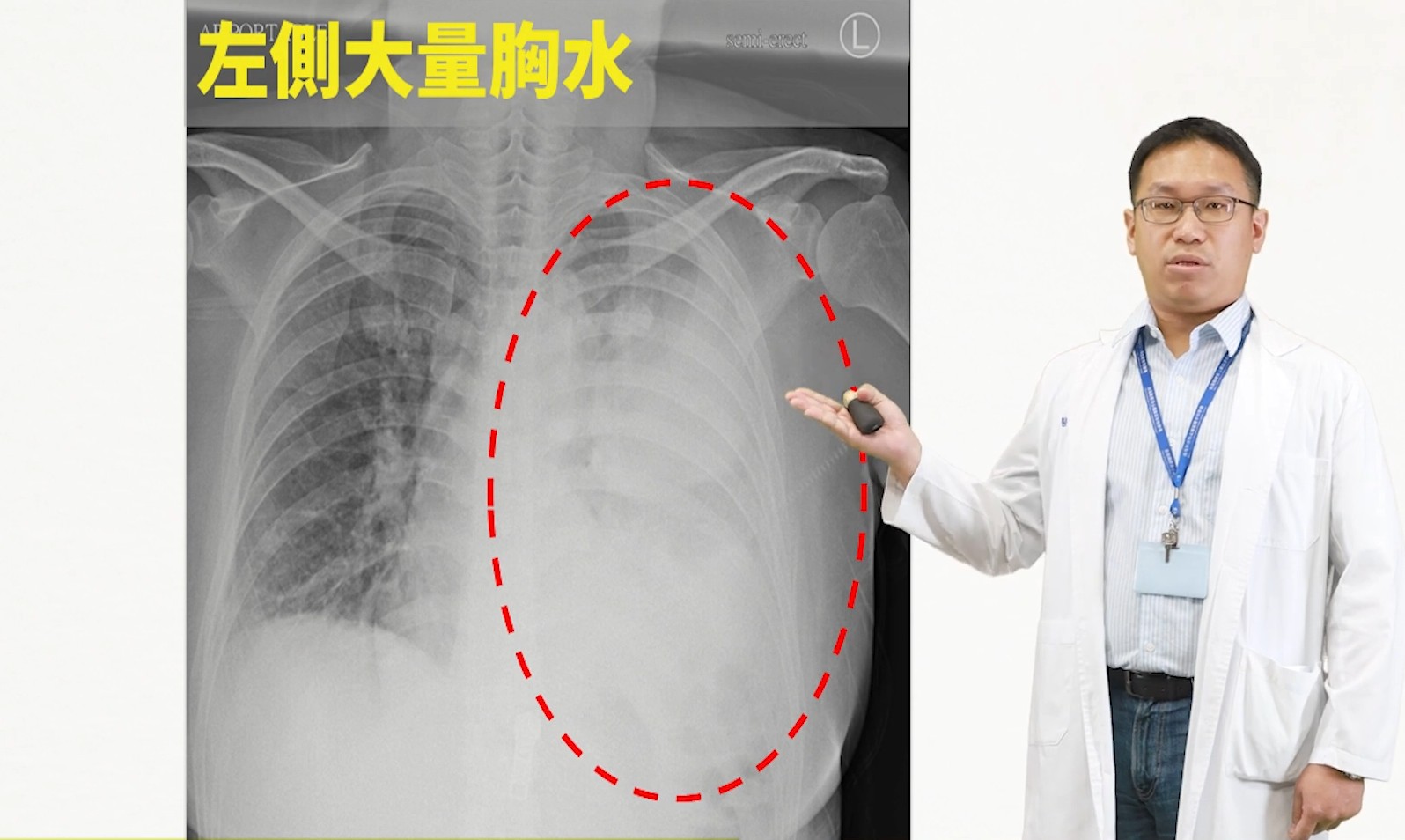 咳嗽帶痰、呼吸會痛以為只是感冒，發燒變喘送醫才知是「膿胸」-成大醫院