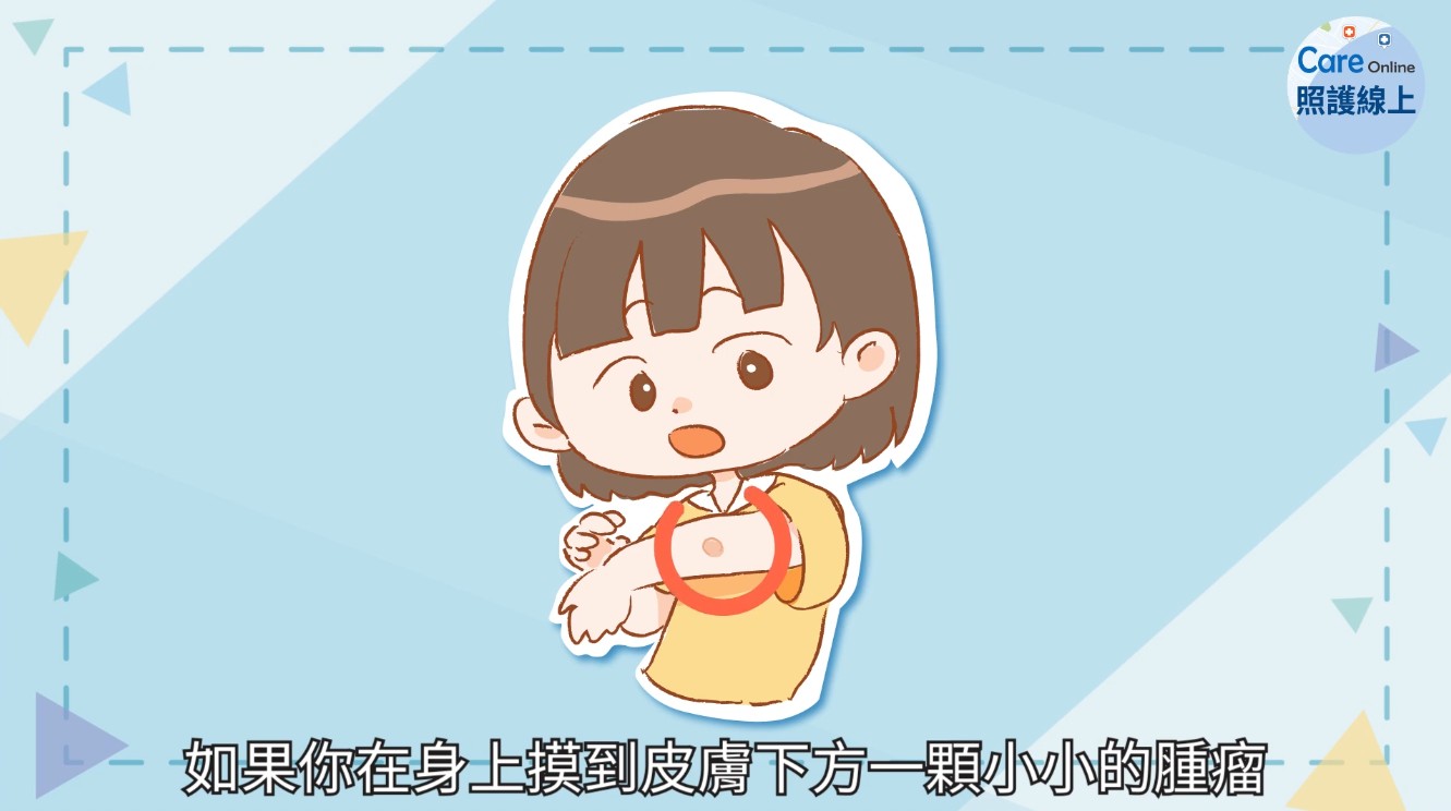 【名醫專訪】粉瘤、粉刺怎麼分？手術切除還是不管它？徹底根治僅1招-皮囊腫