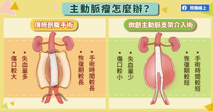 【名醫專訪】痛到換任何姿勢都無法緩解！主動脈瘤不是癌，卻相當致命-主動脈支架
