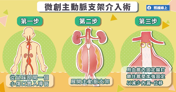 【名醫專訪】痛到換任何姿勢都無法緩解！主動脈瘤不是癌，卻相當致命-主動脈支架