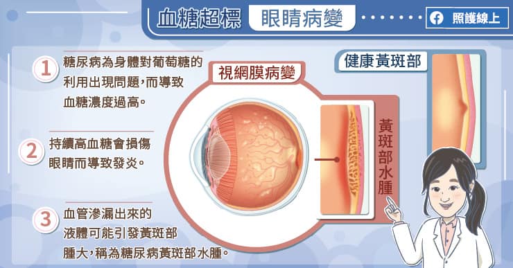 【名醫專訪】視力模糊有暗影看不清路名號誌，竟是糖尿病惹的禍!?-血糖過高