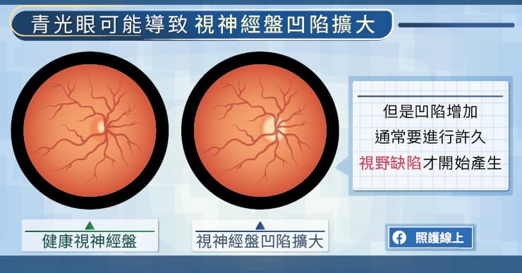 【名醫專訪】青光眼來襲，多數人沒自覺！光測眼壓不夠，還要檢查視野缺損-王清泓醫師