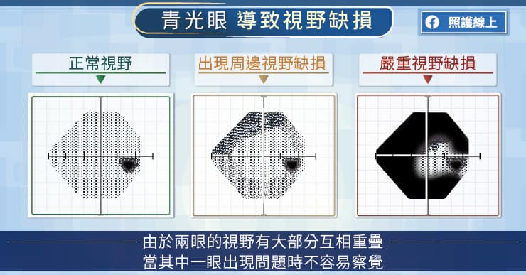 【名醫專訪】青光眼來襲，多數人沒自覺！光測眼壓不夠，還要檢查視野缺損-王清泓醫師