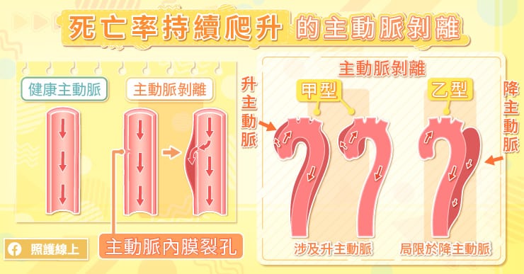 【名醫專訪】36歲男下肢突癱瘓竟是主動脈剝離！不只是胸痛，腹痛、呼吸急促都要留意-乙型主動脈剝離