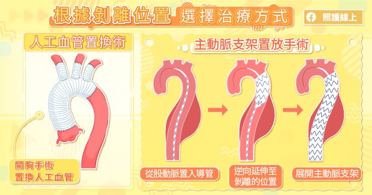 【名醫專訪】36歲男下肢突癱瘓竟是主動脈剝離！不只是胸痛，腹痛、呼吸急促都要留意-乙型主動脈剝離