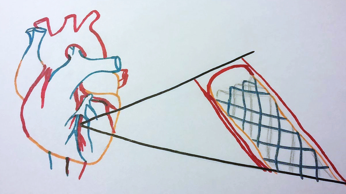 名醫專訪》關於心臟支架你認識多少？每個人都要知道的護心救命知識-心臟支架