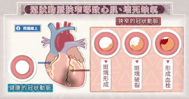 名醫專訪》心臟缺血很要命！醫師圖解冠狀動脈狹窄帶來這些問題-心絞痛
