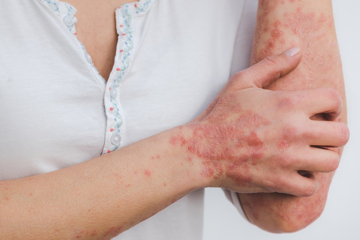 名醫專訪》乾癬不只是皮膚病！免疫拉警報器官都發炎，還有隱藏共病-口服免疫調節劑