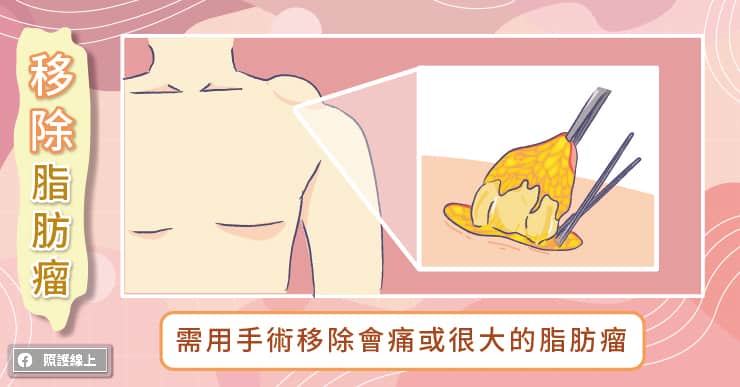 跟體脂肪無關，脂肪瘤怎麼辦？