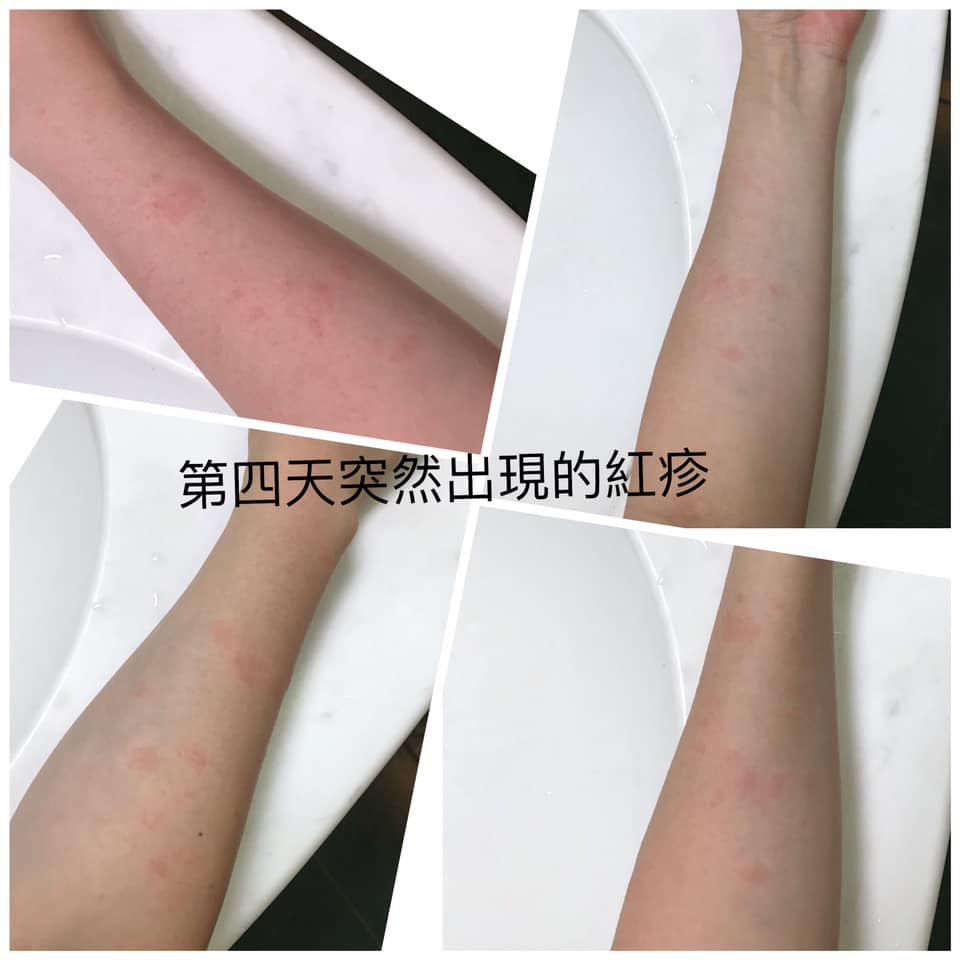 護理師打莫德納寫「5天注射日誌」,接種後手臂紅腫、熱痛症狀-COVID-19 護理師打莫德納寫「5天注射日誌」,接種後手臂紅腫、熱痛症狀-COVID-19