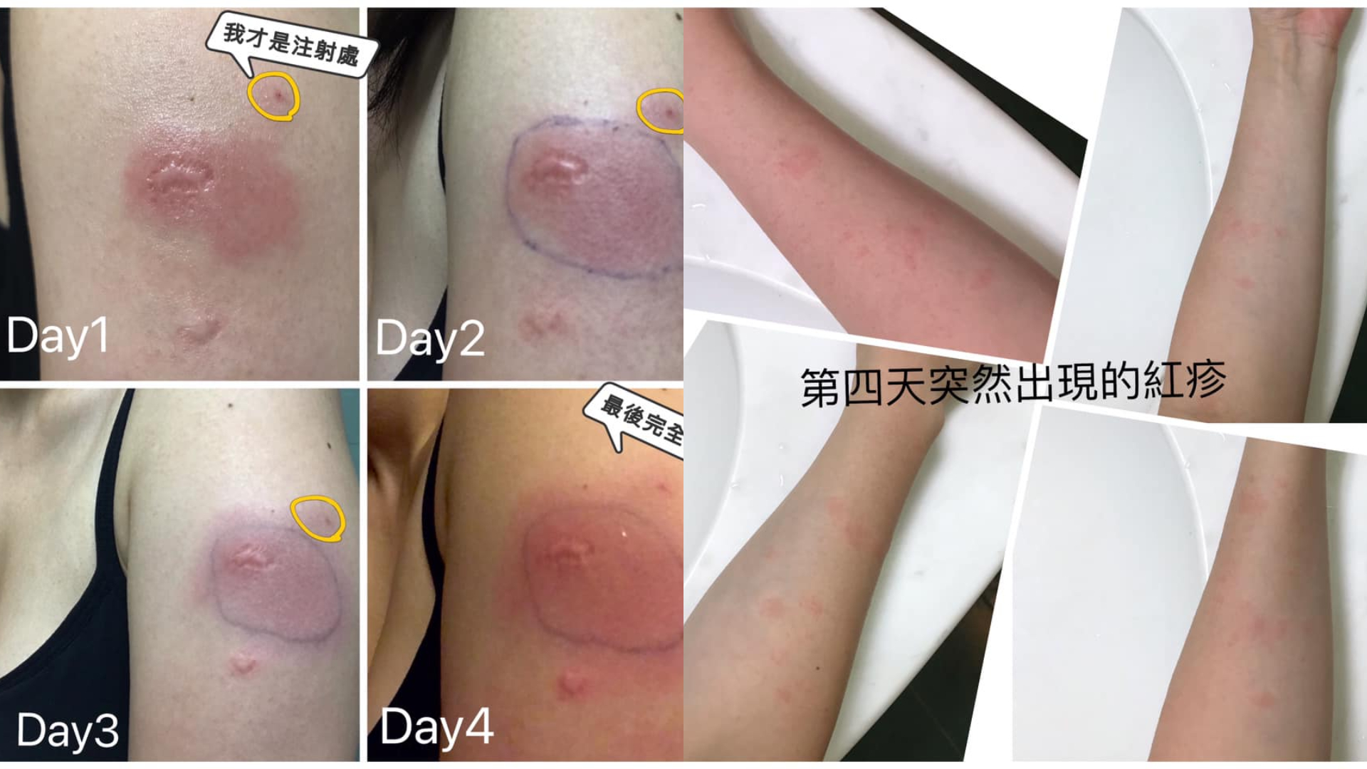 護理師打莫德納寫「5天注射日誌」，接種後手臂紅腫、熱痛症狀