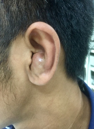 柔道耳是什麼？ 醫：耳廓假性囊腫