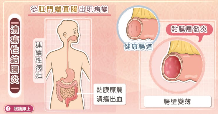 名醫專訪》瀉肚子，停不了！竟然是發炎性腸道疾病-大腸鏡