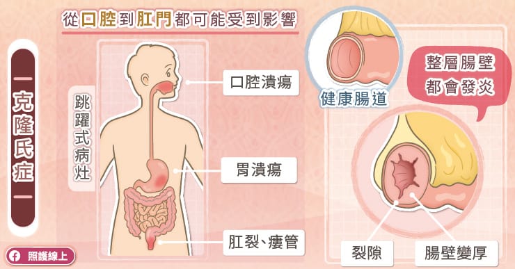 名醫專訪》瀉肚子，停不了！竟然是發炎性腸道疾病-大腸鏡