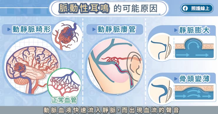 「耳鳴」可能和腦血管病變有關！3症狀恐腦血管病變前兆-中風