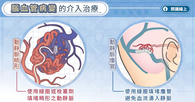 「耳鳴」可能和腦血管病變有關！3症狀恐腦血管病變前兆-中風