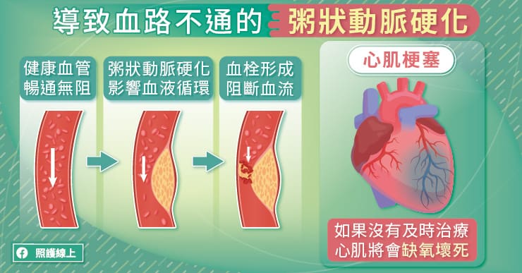 心肌梗塞超危急！搶通血路、預防再發，心臟科醫師圖文講解-心肌梗塞