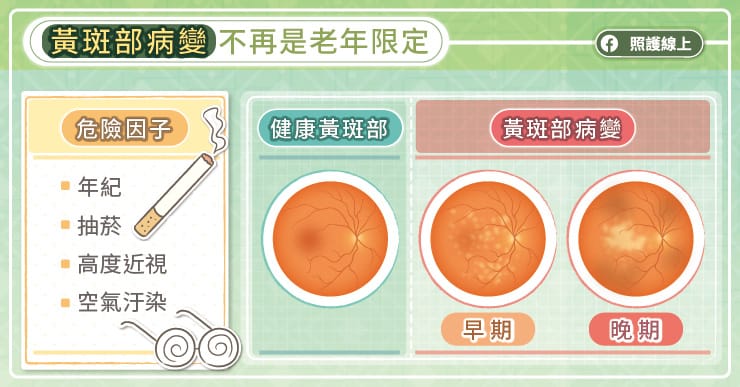 護理師輪三班太超，視力僅剩0.3！醫師證明黃斑部病變逐漸年輕化-Amsler grid