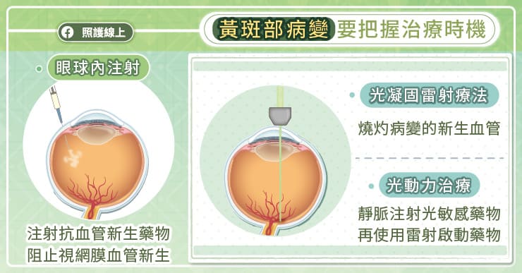 護理師輪三班太超，視力僅剩0.3！醫師證明黃斑部病變逐漸年輕化-Amsler grid