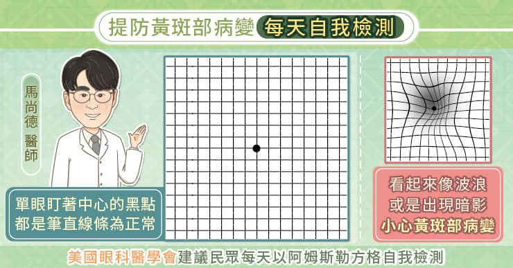 護理師輪三班太超，視力僅剩0.3！醫師證明黃斑部病變逐漸年輕化-Amsler grid