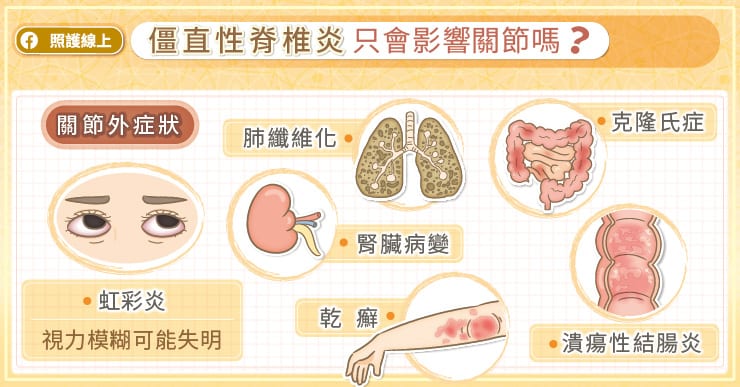 僵直性脊椎炎，迷思要破解！醫師圖文剖析