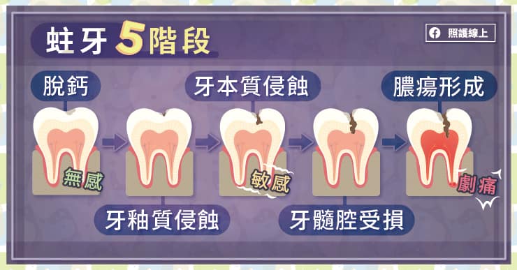 氟漆、氟膠有何差別？正確塗氟預防蛀牙、強化琺瑯質，牙醫師圖文解說-牙托