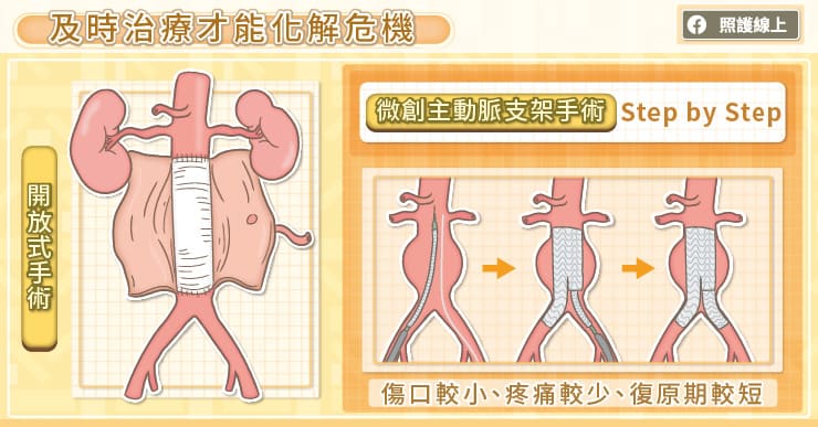 對付困難腹主動脈瘤，血管內固定錨釘很關鍵，心臟血管外科主任圖解說明